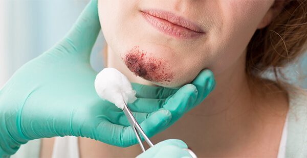 Cranio Facial Trauma